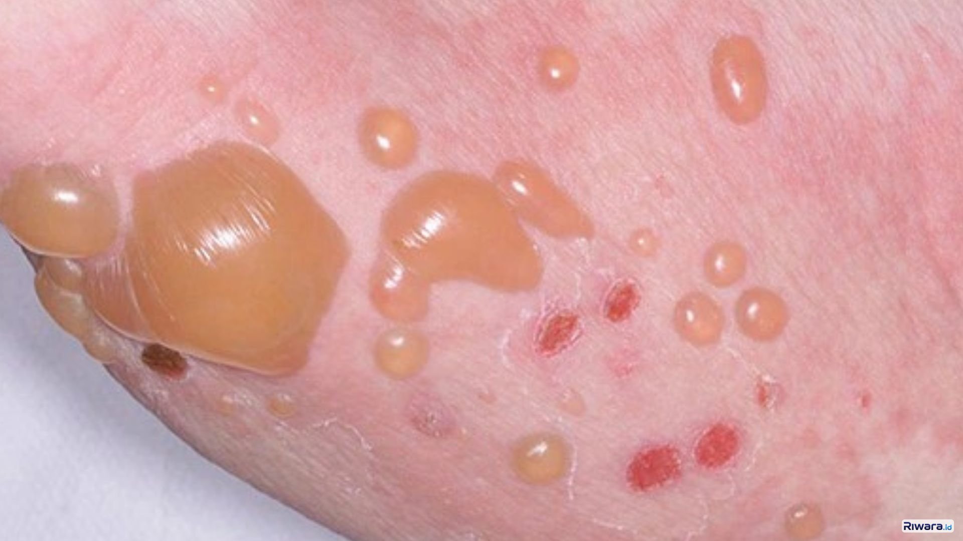 Ilistrasi  penyakit kulit autoimun Bullous pemphigoid pada lansia yang dapat mengancam nyawa.